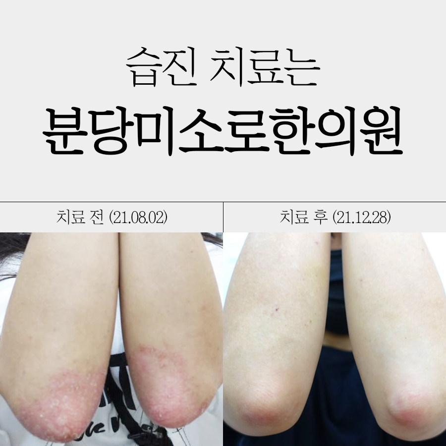 분당 화폐성 습진 치료방법 관련 이미지