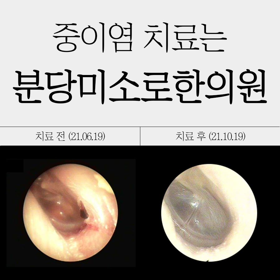 분당 성인 중이염 치료기간 관련 이미지