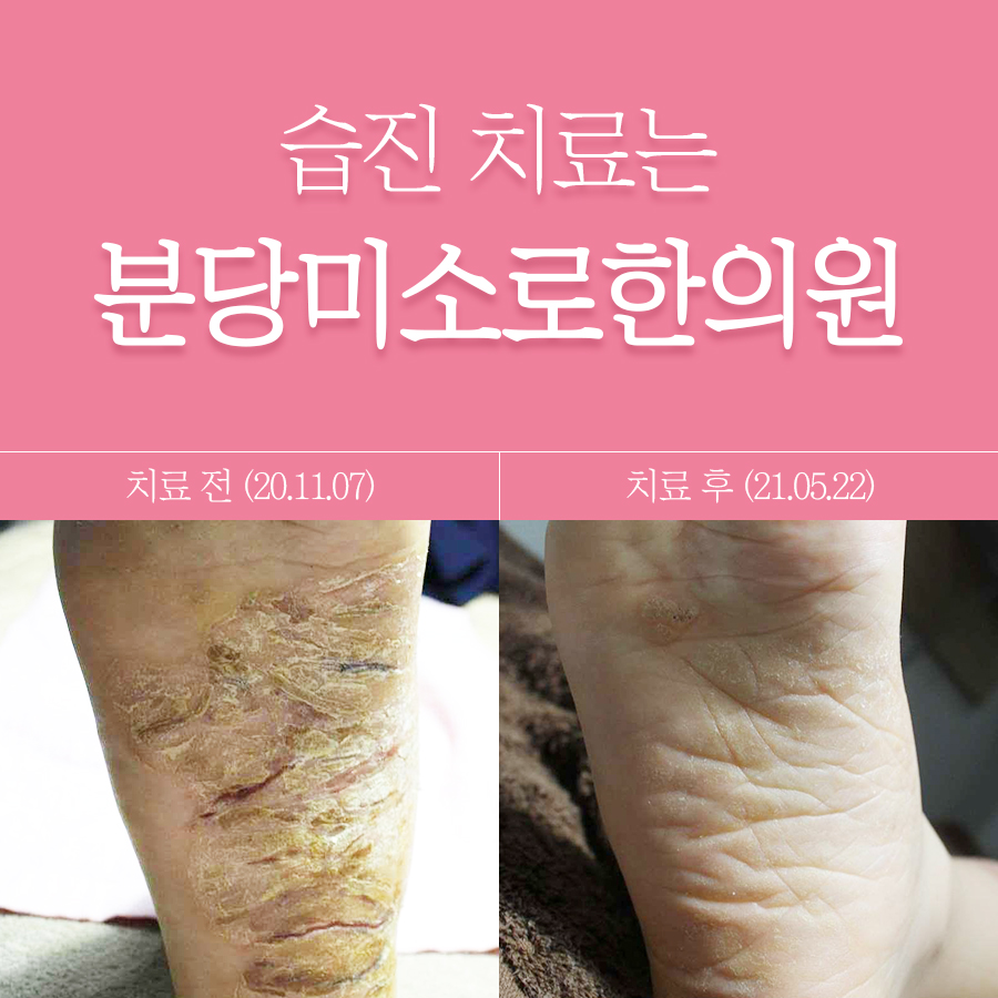 분당 남성 사타구니 습진 관련 이미지