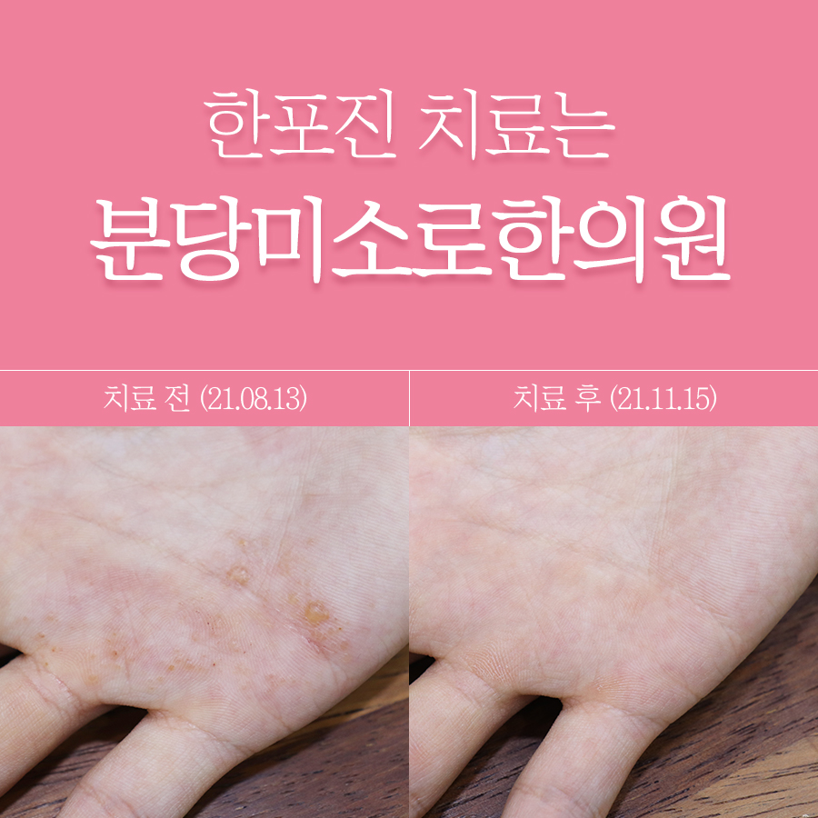 분당 손가락 한포진 연고 리도맥스 관련 이미지