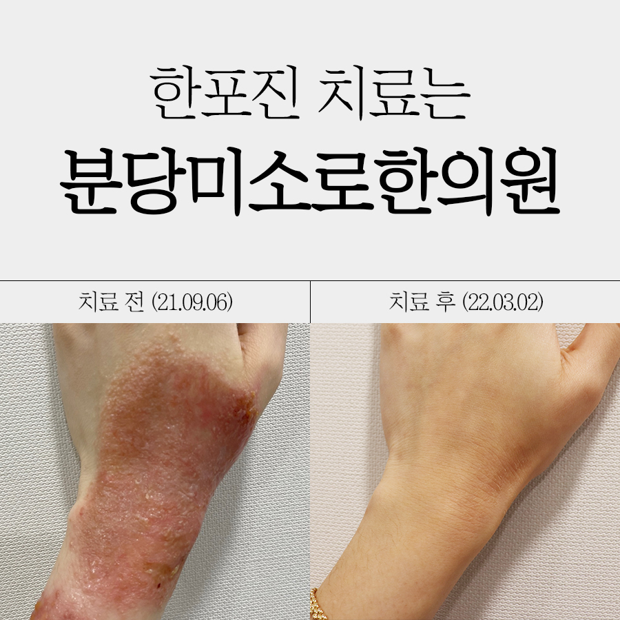 위례 손 한포진 치료 관련 이미지