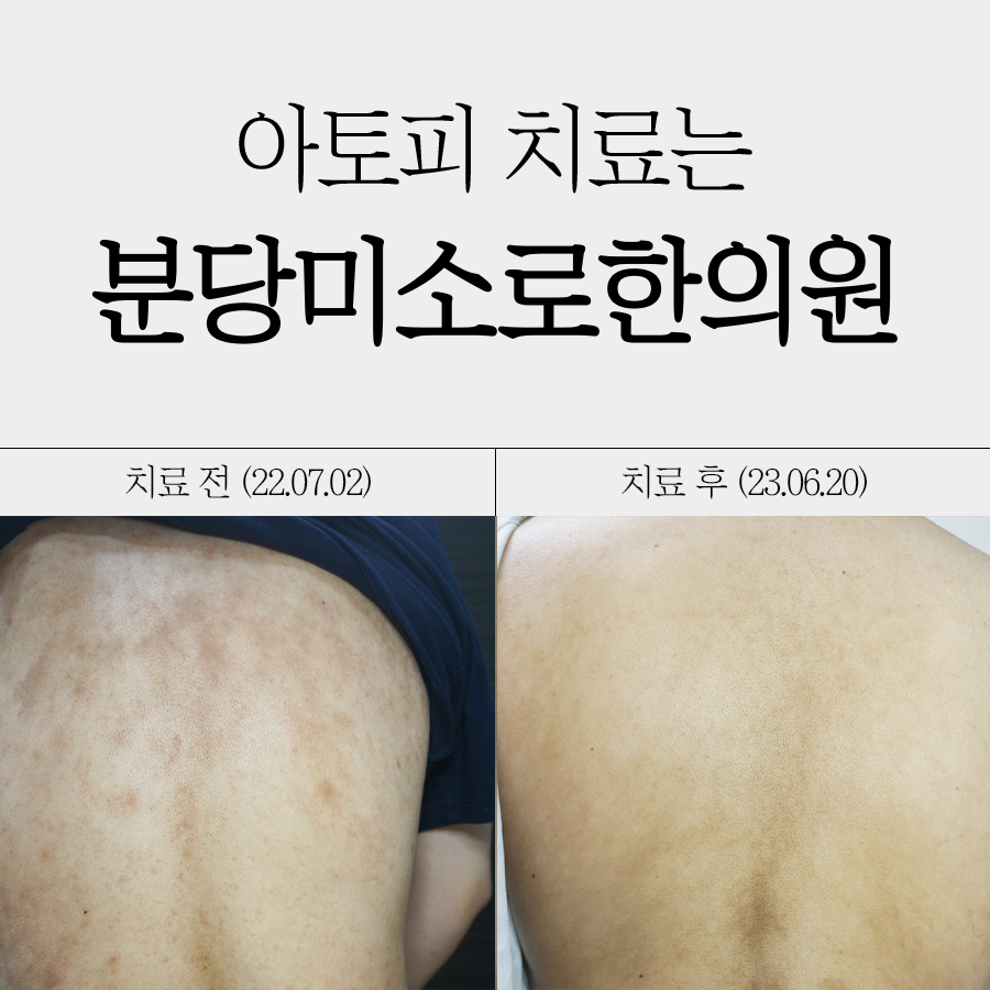 용인성인아토피치료제 관련 이미지