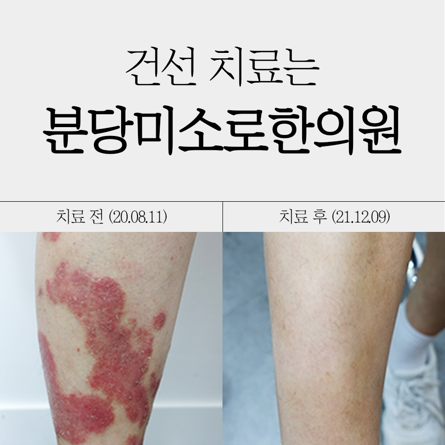 판교 피부과 건선 치료법 관련 이미지
