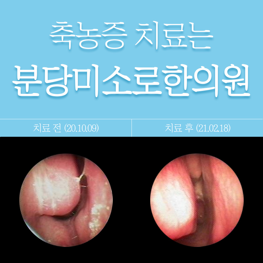 이천 축농증 약 부작용 관련 이미지