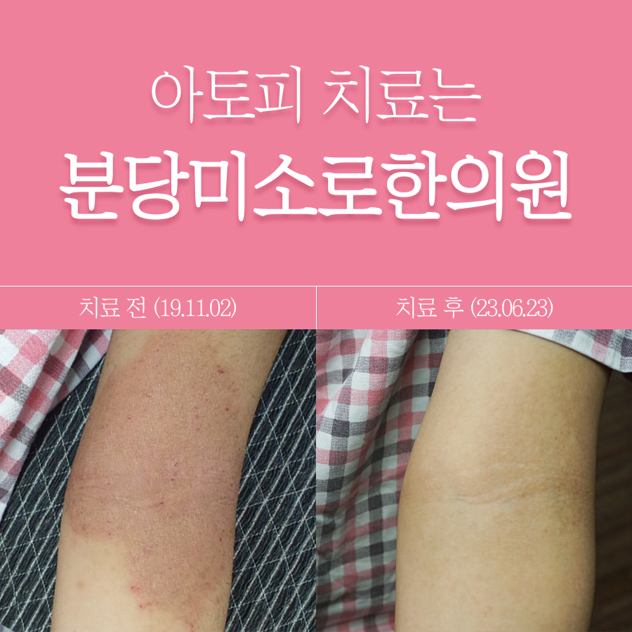용인 아토피에 좋은 약초 관련 이미지
