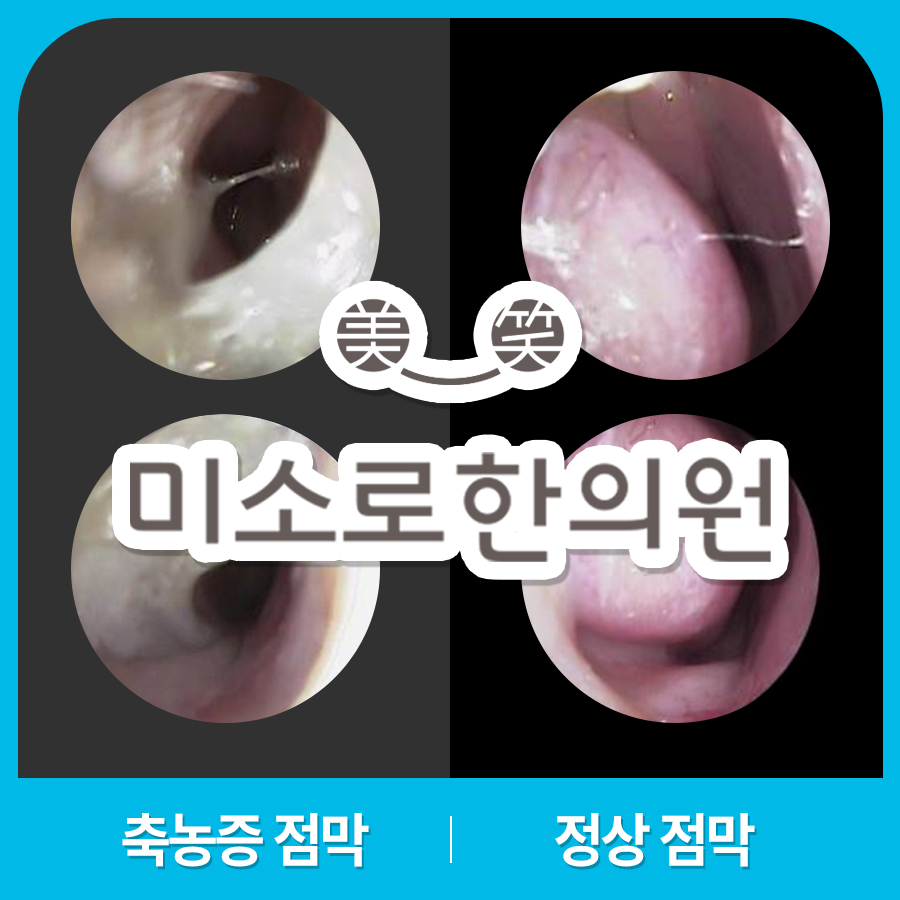 경기광주 비염 축농증 수술 관련 이미지