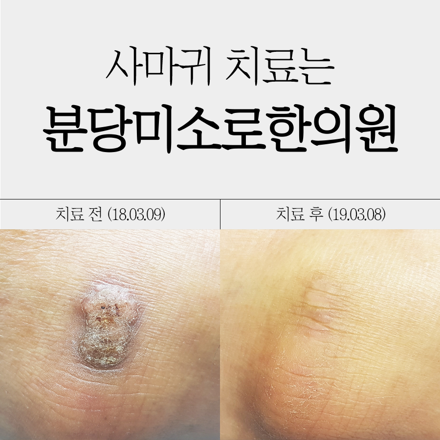 성남 목 사마귀 제거 후 관리 관련 이미지