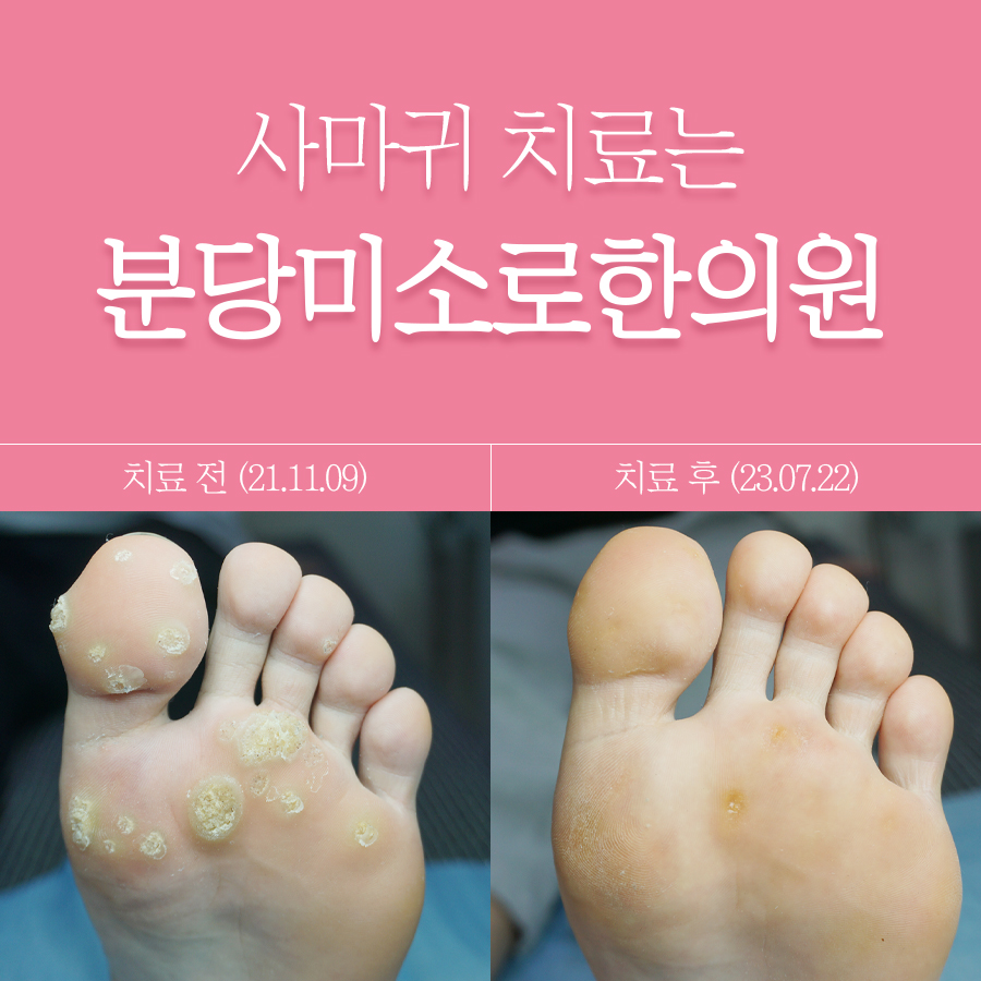 용인 한의원 사마귀 치료 비용 관련 이미지
