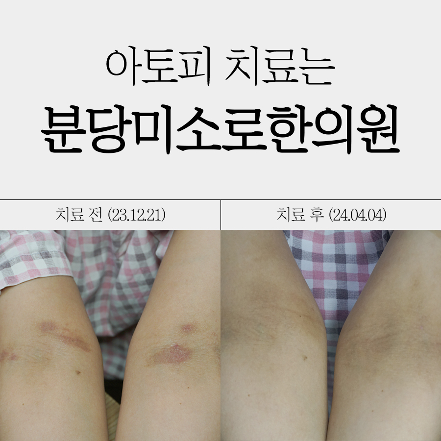 위례 아토피치료한의원 관련 이미지