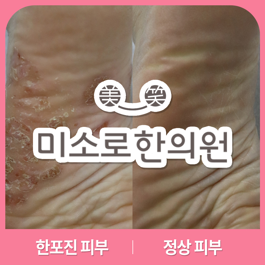 여주 한포진 병원 어디로 관련 이미지