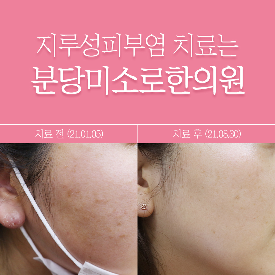 여주 지루성 피부염 피부과 명의 관련 이미지