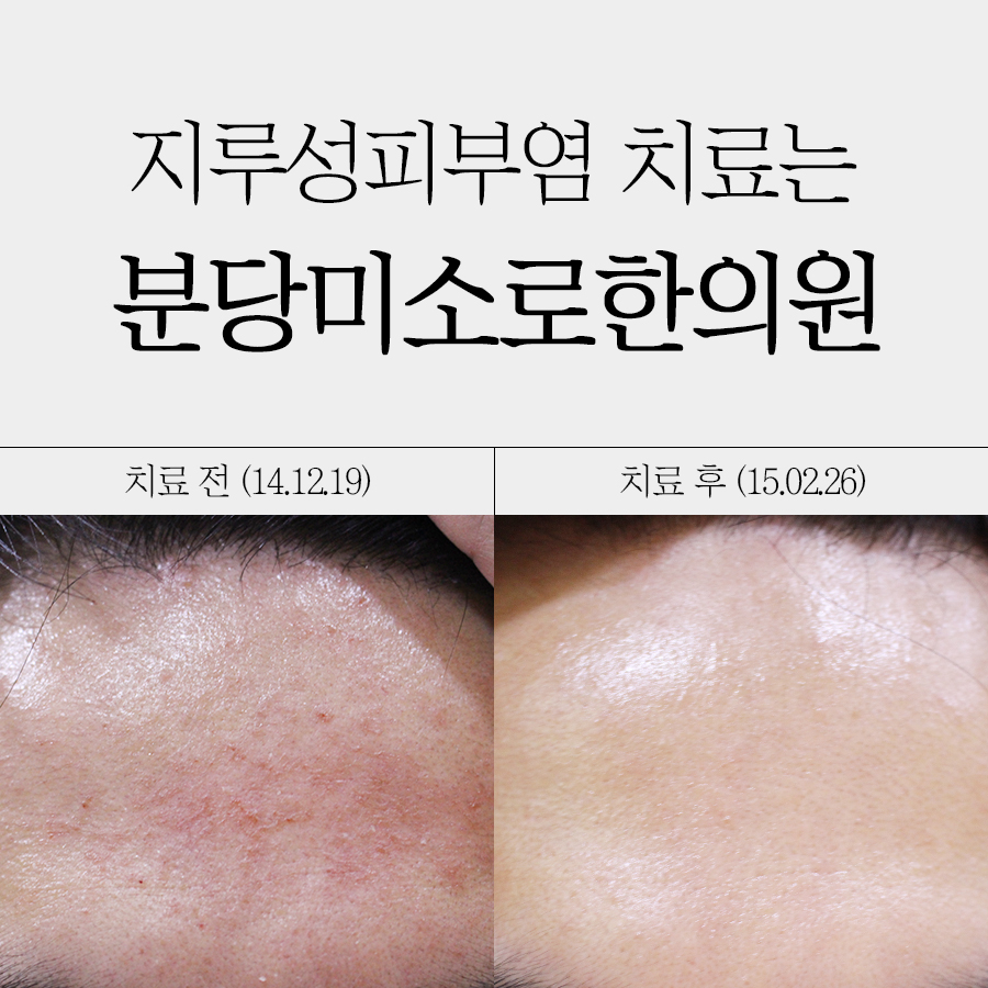 이천 지루성피부염병원 관련 이미지