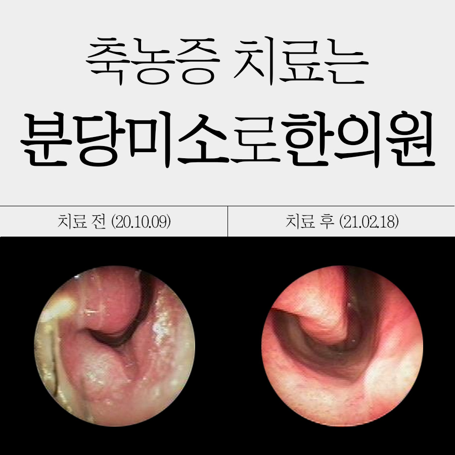 경기광주 급성 부비동염 증상 관련 이미지