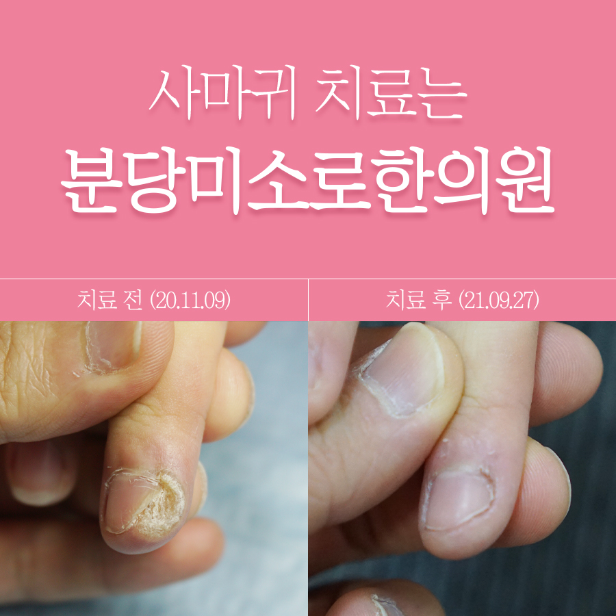 경기광주 발바닥 사마귀 치료법 관련 이미지