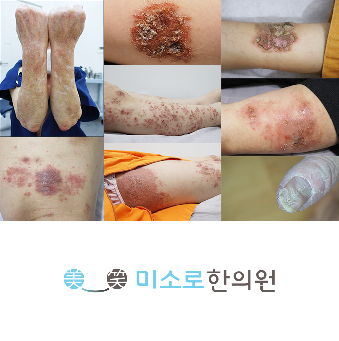 분당 사타구니 습진 병원 어디로 관련 이미지